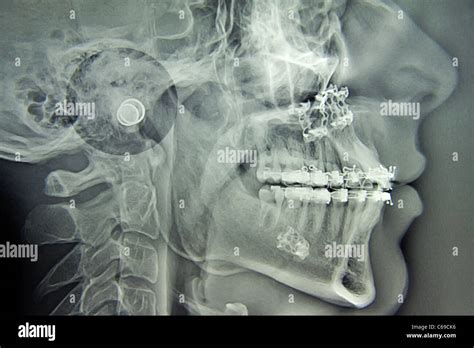 Maxilla mandible hi-res stock photography and images - Alamy