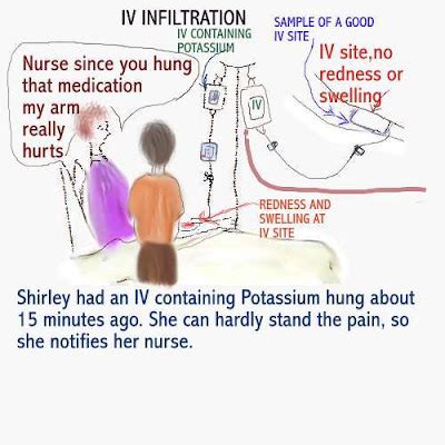 Dear Nurses: IV INFILTRATION