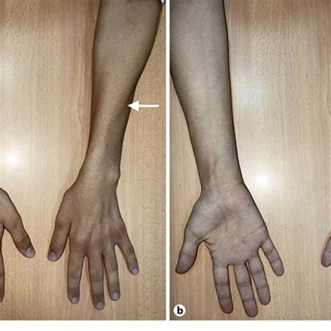 (PDF) Monomelic Amyotrophy (Hirayama Disease): A Rare Case Report and ...