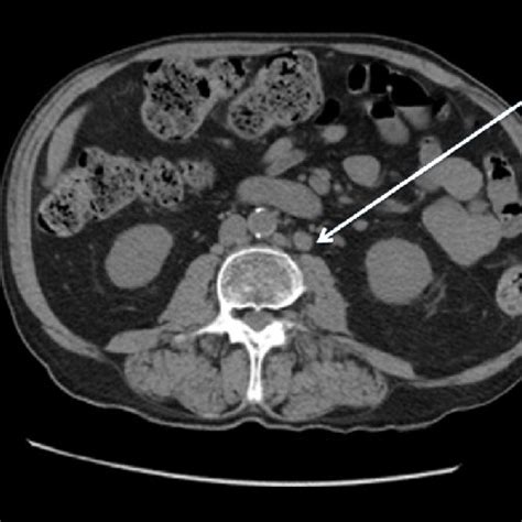 Para Aortic Lymph Node Mass Axial Ct Scan Showing A Para Aortic Lymph ...