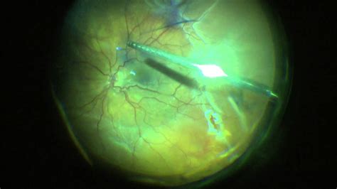 Retinal Detachment Repair with Vitrectomy - YouTube