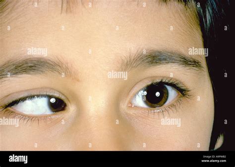 Lateral rectus palsy Stock Photo - Alamy