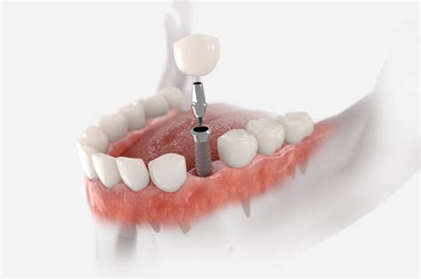 Dental Implant Procedure Pain: How Do Dentists Turn It Into Comfort?