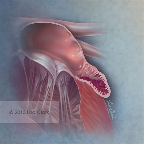 Left Atrial Appendage Thrombus – Artists' Blogs :: Medical Illustration Sourcebook