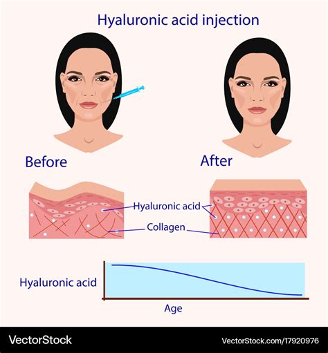 Hyaluronic Acid Buttock Injections Side Effects - TheSacredIcons