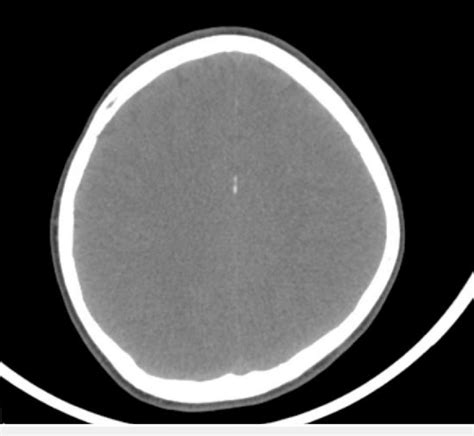 CT scan showing calcification of falx cerebri and tentorium | Download Scientific Diagram