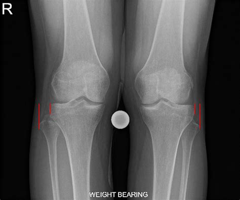 Distal Tibiofibular Joint