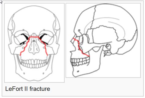 Facial Fracture Management Handbook - LeFort Fractures | Iowa Head and Neck Protocols