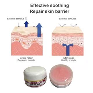 Keloid Scar Removal Cream | Shopee Singapore