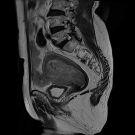 Endometrial carcinoma (staging) | Radiology Reference Article | Radiopaedia.org