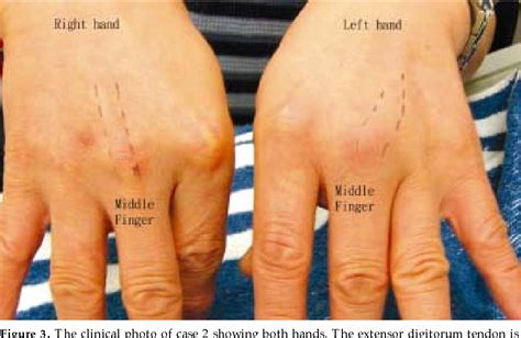 Figure 3 from Boxer'S Knuckle of Non-Boxer Patients | Semantic Scholar