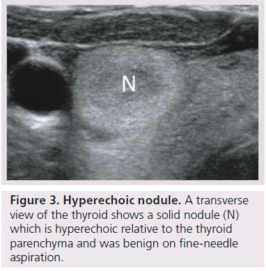 Thyroid nodule sonography: assessment for risk of malignancy