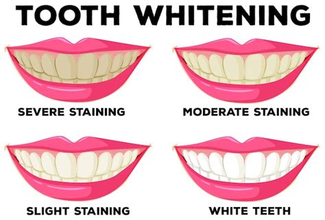 Premium Vector | Process of tooth whitening