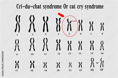 Cri du chat syndrome , also known as 5p- (5p minus) syndrome or cat cry ...