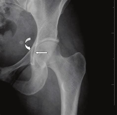 A frontal radiograph of the left hip featuring a coxa profunda which is ...