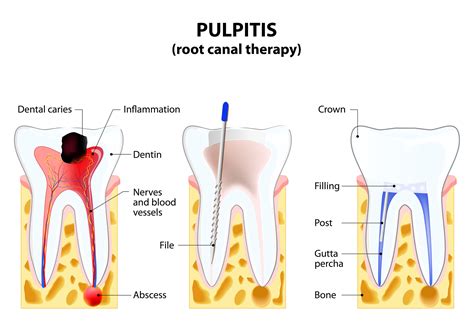 Root Canal Therapy - Smile Center Villa Rica