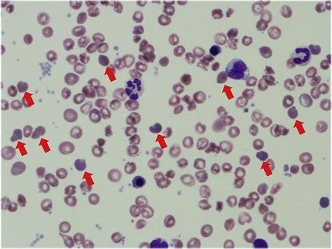 Infantile pyknocytosis with marked hemolytic anemia - Pediatrics ...