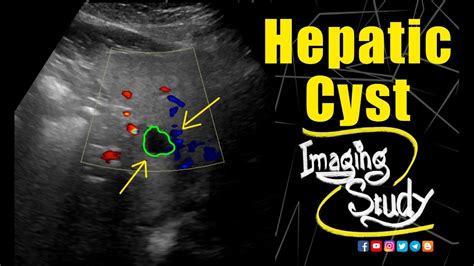 Hepatic Cyst || Ultrasound || Case 212 - YouTube