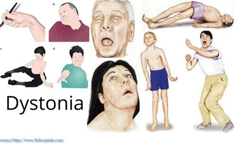 Dystonia-Symptoms, Causes, and treatments.| Dr. Gurneet Sawhney