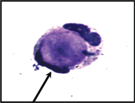 Detection of lupus pleuritis: a tale of lights and shadows