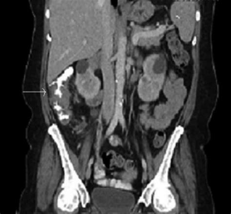 CT scan of abdomen with contrast with apple-core lesion in ascending... | Download Scientific ...