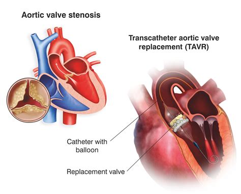 TAVR: Transcatheter Aortic Valve Replacement | Meril Life