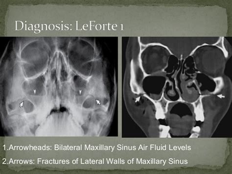 Lefort 1 Fracture