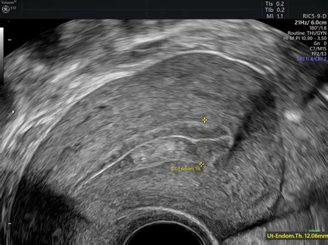 Making the Diagnosis With Endometrial Hyperplasia Ultrasound | Empowered Women's Health