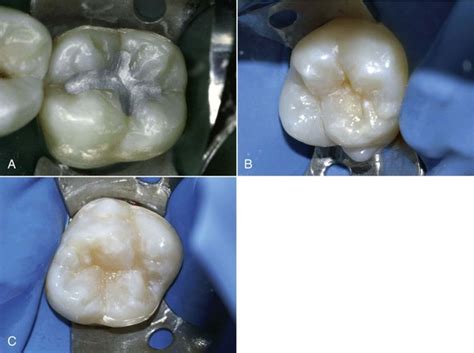 5: Silver Amalgam and Current Applications | Pocket Dentistry