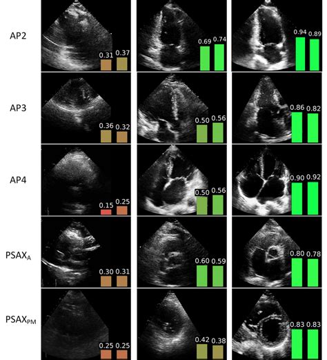 Sample test results for the five standard echo imaging planes. The left ...