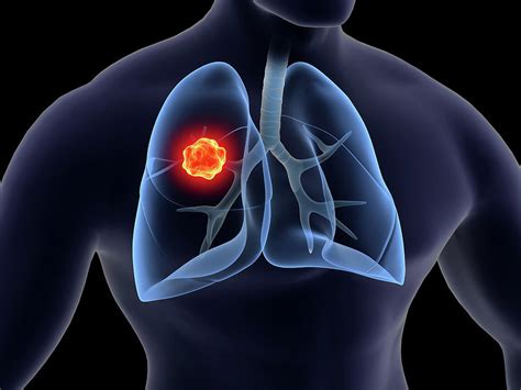 Medical Illustration Of Lung Cancer Photograph by Stocktrek Images | Pixels