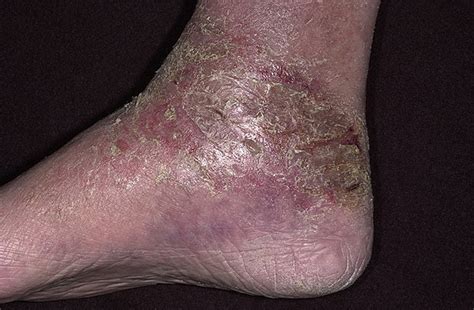 Stasis Dermatitis on Legs Pictures – 174 Photos & Images / illnessee.com