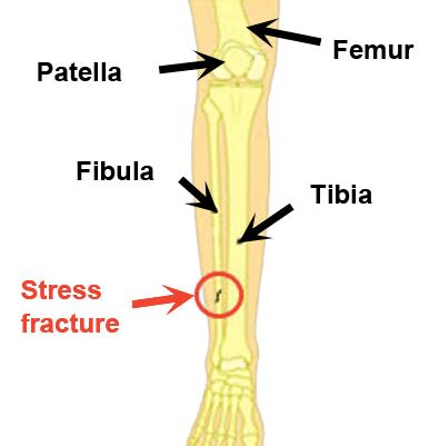 Stress Fracture Tibia Bone Scan