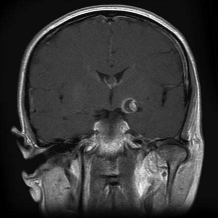 Brain Aneurysm Mri : 4 Intracranial Aneurysms Radiology Key - A brain aneurysm can result from a ...