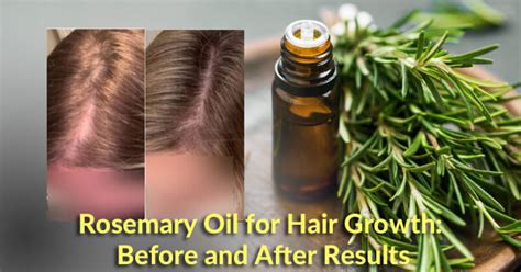 Rosemary Oil For Hair Growth Before And After Pictures & Usage » SkinOl Cosmetics