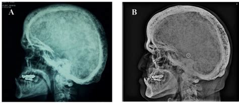 Enlivening the radiographic features of Paget disease | BMJ Case Reports