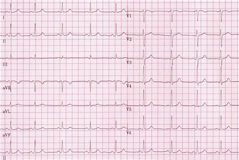 How to read an ECG - wikidoc