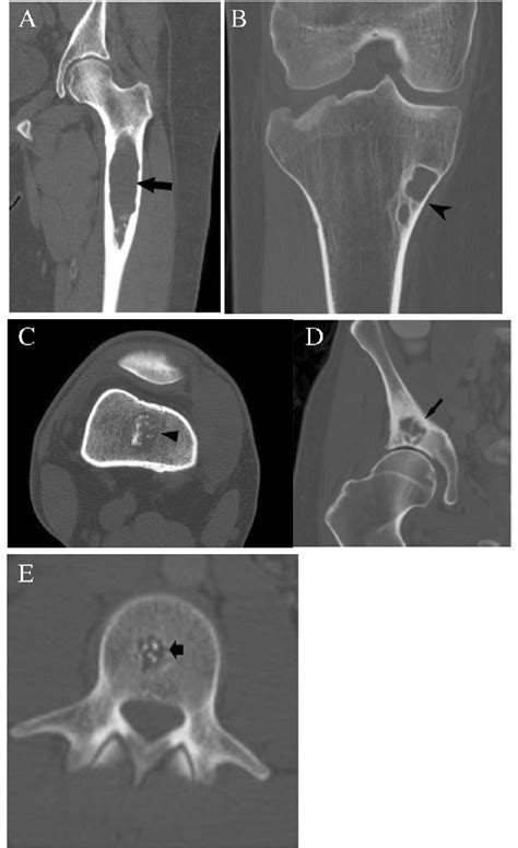 Characteristic CT lucent lesions. A Coronal CT image shows a lucent... | Download Scientific Diagram