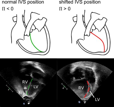 Interventricular Septum Heart