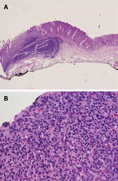 Early-stage primary signet ring cell carcinoma of the colon