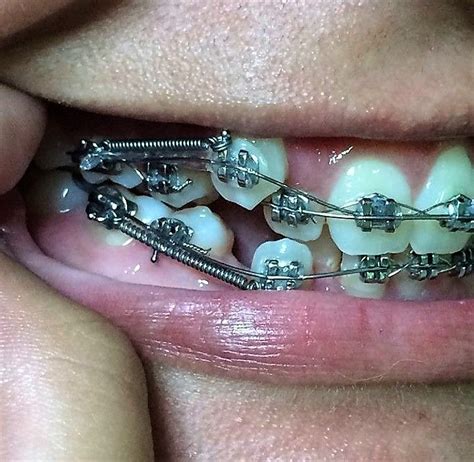 Pin By John Beeson On Girls In Braces Orthodontics Orthodontic | My XXX Hot Girl