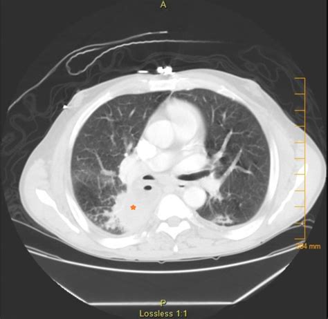 Levamisole-induced Vasculitis in a Hepatitis C Patient: A General ...