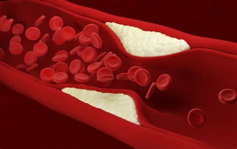 What Is Arterial Plaque? - PAD Treatment Centers | USA Vascular Centers