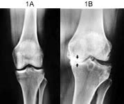 Dr. Ashutosh Mavalankar - Osteoarthritis of Knee