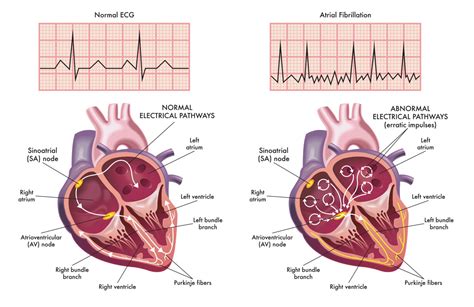 Difference between Atrial Fibrillation and Atrial Flutter | Pulse ...