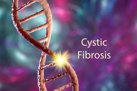 Retroperitoneal Fibrosis Causes Symptoms Treatment