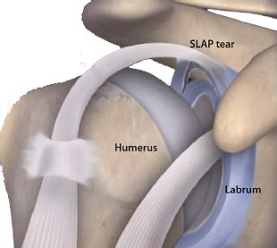 Shoulder Labral Tear Types