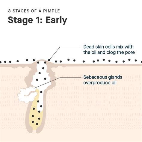 The Life Cycle of a Pimple – SLMD Skincare by Sandra Lee, M.D. - Dr ...