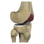 Knee Arthritis Raleigh NC | Knee Instability Durham | Knee Fracture Cary NC