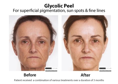 Glycolic Peel | Glycolic Acid | Skin Renewal